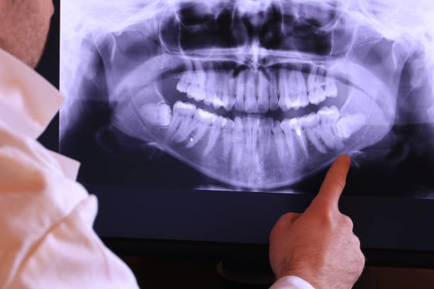 Best Dentist for Tooth Abscess  in Zwolle, LA